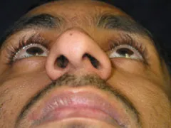 Before Rhinoplasty