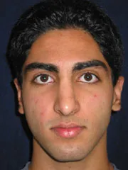 After Rhinoplasty