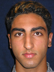 Before Rhinoplasty
