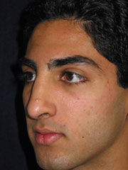 After Rhinoplasty
