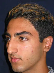 Before Rhinoplasty