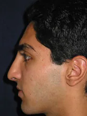 After Rhinoplasty