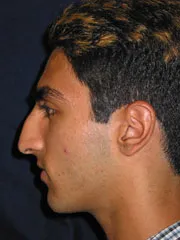 Before Rhinoplasty