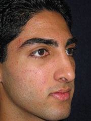 After Rhinoplasty