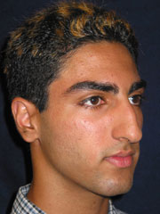Before Rhinoplasty