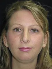 After Rhinoplasty