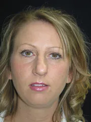 Before Rhinoplasty