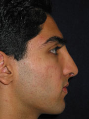 After Rhinoplasty