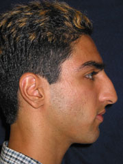 Before Rhinoplasty