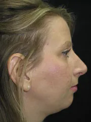 After Rhinoplasty
