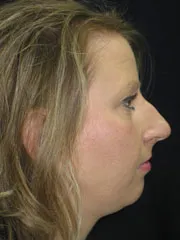 Before Rhinoplasty