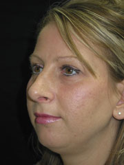 After Rhinoplasty