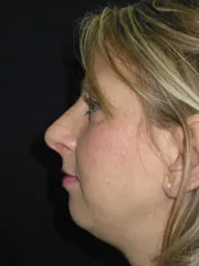 After Rhinoplasty