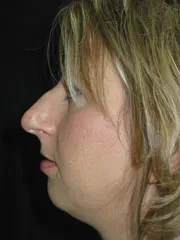 Before Rhinoplasty