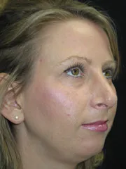 After Rhinoplasty