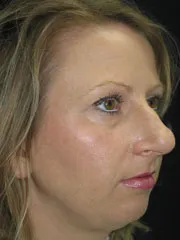 Before Rhinoplasty