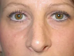 After Rhinoplasty