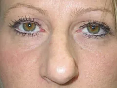 Before Rhinoplasty
