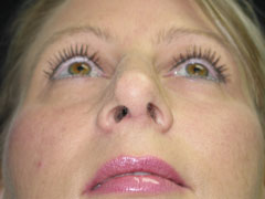 After Rhinoplasty