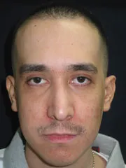 After Rhinoplasty