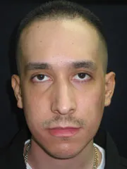Before Rhinoplasty