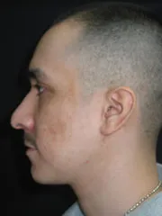 After Rhinoplasty
