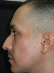 Before Rhinoplasty