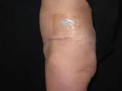 After Tummy Tuck, Liposuction