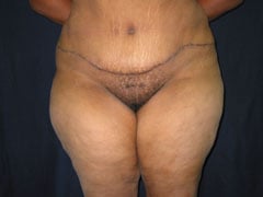 After Tummy Tuck, Liposuction