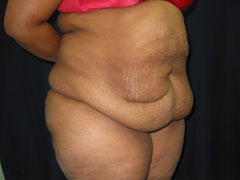 Before Tummy Tuck, Liposuction
