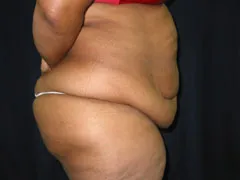 Before Tummy Tuck, Liposuction