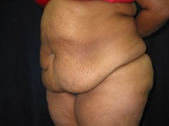 Before Tummy Tuck, Liposuction