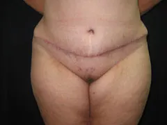 After Tummy Tuck, Liposuction
