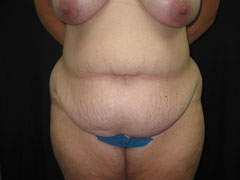 Before Tummy Tuck, Liposuction