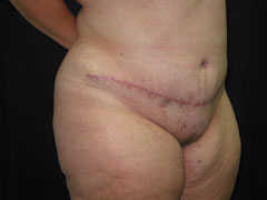 After Tummy Tuck, Liposuction
