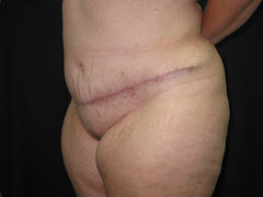 After Tummy Tuck, Liposuction