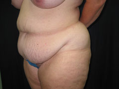 Before Tummy Tuck, Liposuction