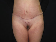 After Tummy Tuck, Liposuction
