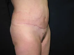 After Tummy Tuck, Liposuction