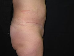 After Tummy Tuck, Liposuction