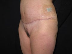 After Tummy Tuck, Liposuction