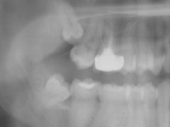 Before Impacted Wisdom Teeth