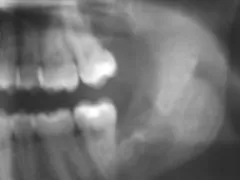 After Impacted Wisdom Teeth