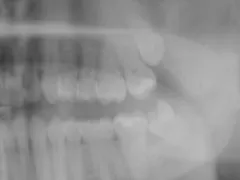 Before Impacted Wisdom Teeth