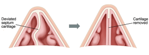 Deviated septum cartilage remove Inland Empire
