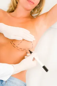 marking up for breast implants