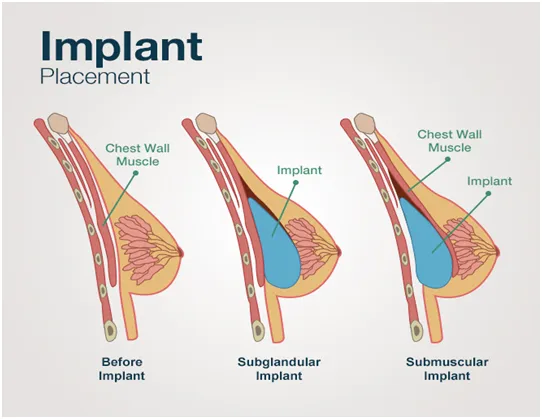 Breast Implants Inland Empire  Breast Augmentation Inland Empire CA