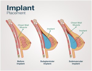 breast-implants-inland-empire