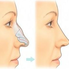 Profile-view-nose-job-Inland-Empire