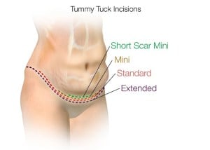tummy-tuck-incision-mommy-make over